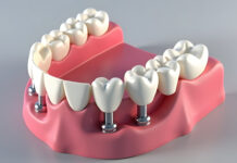 bone grafting