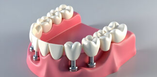 bone grafting